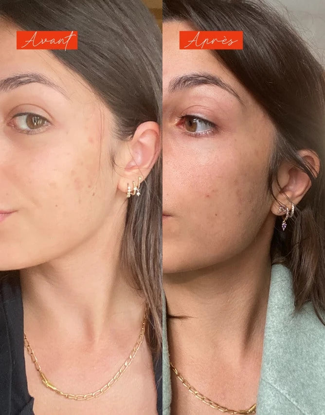 Routine peau à imperfections et tâches