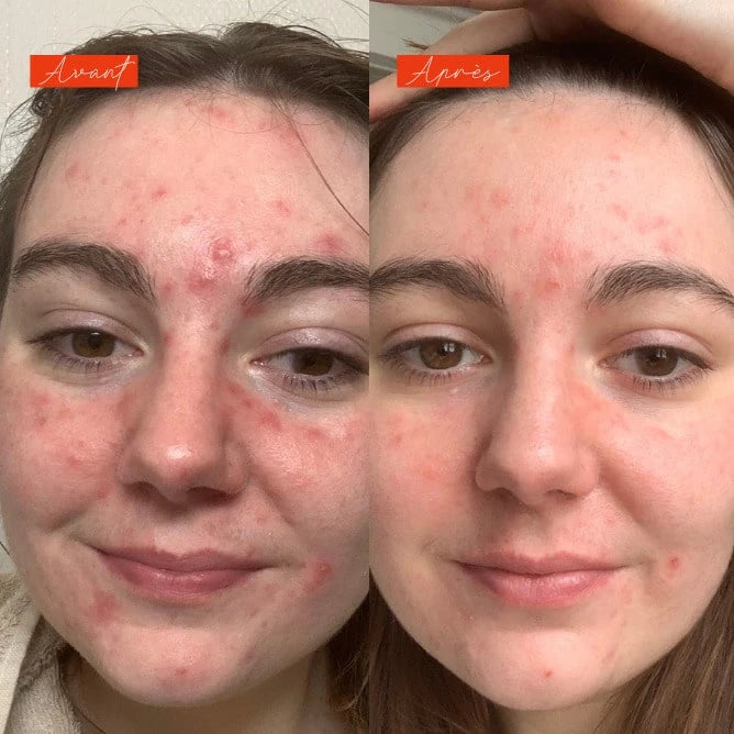Lundi matin - Actif anti imperfections