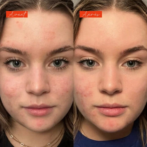 Lundi matin - Actif anti imperfections